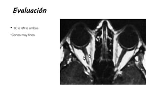 Evaluación
• TC o RM o ambas
*Cortes muy finos
 