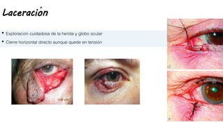 Laceración
• Exploracion cuidadosa de la herida y globo ocular
• Cierre horizontal directo aunque quede en tensión
 