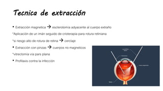 Tecnica de extracción
• Extracción magnetica  esclerotomía adyacente al cuerpo extraño
*Aplicación de un imán seguido de crioterapia para rotura retiniana
*si riesgo alto de rotura de retina  cerclaje
• Extracción con pinzas  cuerpos no magneticos
*vitrectomía vía pars plana
• Profilaxis contra la infección
 