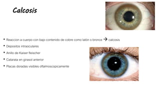 Calcosis
• Reaccion a cuerpo con bajo contenido de cobre como latón o bronce  calcosis
• Depositos intraoculares
• Anillo de Kaiser fleischer
• Catarata en girasol anterior
• Placas doradas visibles oftalmoscopicamente
 
