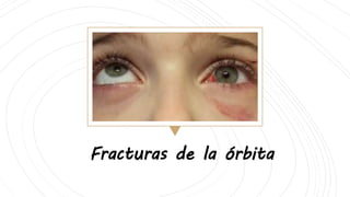 Fracturas de la órbita
 