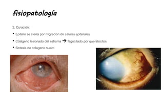 fisiopatología
2. Curación:
• Epitelio se cierra por migración de células epiteliales
• Colágeno lesionado del estroma  fagocitado por queratocitos
• Sintesis de colageno nuevo
 