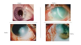 Grado 1
Grado 2
Grado 4
Grado 3
 