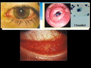 Adultos  limita al ojo
Niños  Síntomas sistémicos de infección viral, como
fiebre, faringitis, otitis media y diarrea

N...