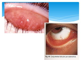 Úlceras corneales  desbridamiento de la córnea mediante
fricción suave de la úlcera con un hisopo de algodón seco,
se apl...