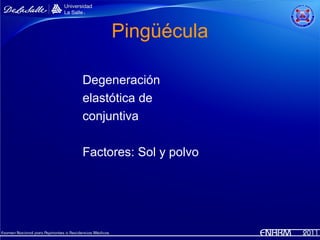 Pingüécula

Degeneración
elastótica de
conjuntiva

Factores: Sol y polvo
 
