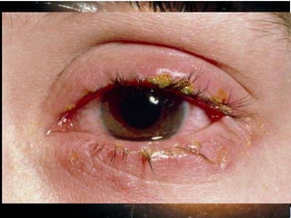 • Sinais característicos:
I. Hiperemia conjuntival de predomínio periférico
II. Diversos tipos de secreção
III. Conjuntiva tarsal inflamada (papilas, folículos,
pseudomembranas ou membranas)
IV. Blefarite associada
Conjuntivite:
 