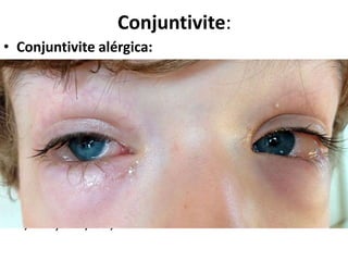 • Conjuntivite alérgica:
• Hipersensibilidade tipo I
• Ácaros, gatos, mofo etc
• Início abrupto
• Afeta os 2 olhos simultaneamente
• Lacrimejamento, secreção mucoide, quemose e
prurido intenso
• Autolimitada
• Colírios de anti-histamínicos-H1 (levocabastina
0,05%) . 4x/dia, até 2 semanas
Conjuntivite:
 