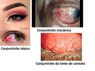 Conjuntivite tóxica
Conjuntivite mecânica
Conjuntivite da lente de contato
 