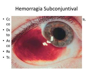 Hemorragia Subconjuntival
• Coleção de sangue entre a conjuntiva e esclera,
com margens limitadas
• Decorrente de um pequeno trauma, crise de
tosse ou vômitos.
• Associada a Hipertensão, diabetes, uso de
corticoide etc
• Remissão espontânea
• Tranquilizar paciente
 