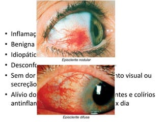 Episclerite
• Inflamação aguda da episclera
• Benigna e autolimitada
• Idiopática(70%)
• Desconforto ocular, lacrimejamento
• Sem dor ocular, fotofobia, borramento visual ou
secreção
• Alívio dos sintomas: colírio lubrificantes e colírios
antinflamatórios(diclofenaco 1%), 4x dia
 