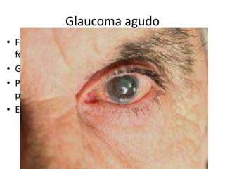 Glaucoma agudo
• Forte dor ocular, diminuição da acuidade visual,
fotofobia e lacrimejamento intenso.
• Globo ocular difusamente vermelho
• Pressão ocular elevada: consistência dura à
palpação bidigital do globo ocular.
• Encaminhamento
 