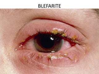 BLEFARITE
• Inflamação crônica das margens palpebrais, com
secreção purulenta
• Sintomas intermitentes: Prurido, queimação e
fincada em palpebras
• Disfunção seborreica, contaminação por
Staphylococcus aureus ou disfunção das glândulas
de Meibomius.
• Pode predispor aparecimento de hordéolos
• Tratamento: Higiene palpebral com xampu neutro
+ pomada de antibiótico
 
