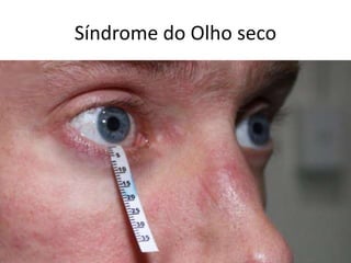 Síndrome do Olho seco
• Redução da produção lacrimal, aumento da
evaporação lacrimal e alteração qualitativas da
lágrima
• Ardência ocular, sensação de corpo estranho,
borramento visual, com variação ao piscar,
vermelhidão e lacrimejamento.
• Diagnóstico: Teste de Schirmer.
• Tratamento: colírios lubrificantes( lágrimas
artificiais).
 
