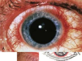 Olho vermelho
Conjuntiva bulbar + conjuntiva
palpebral
Hiperemia perilimbar (entre
córnea e esclera)
Conjuntivite Condições graves: glaucoma e
iridociclite
• Padrão da hiperemia ocular
• Exame pupilar
Glaucoma agudo Iridociclite
Midríase irregular, sem reação a
luz
Miose
 