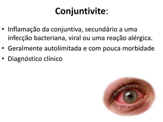 • Inflamação da conjuntiva, secundário a uma
infecção bacteriana, viral ou uma reação alérgica.
• Geralmente autolimitada e com pouca morbidade
• Diagnóstico clínico
Conjuntivite:
 