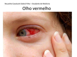 Olho vermelho
Neuzelito Cavalcanti Sobral Filho – Estudante de Medicina
 