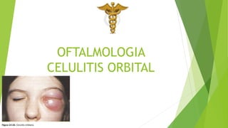 OFTALMOLOGIA
CELULITIS ORBITAL
 