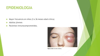EPIDEMIOLOGIA
 Mayor frecuencia en niños (3 a 36 meses edad critica)
 Adultos jóvenes
 Pacientes inmunocomprometidos.
 