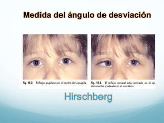 Medida del ángulo de desviación
Hirschberg
 