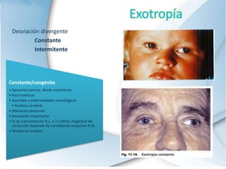 Exotropía
Desviación divergente
Constante
Intermitente
Constante/congénita
• Aparación precoz, desde nacimiento
• Poco habitual
• Asociado a enfermedades neurológicas
• Parálisis cerebral
• Alteración binocular
• Desviación importante
• Tx qx (retroinseción R.L. a 7 a 8mm, magnitud de
corrección depende de cantidad de resección R.M.
• Tendencia recidiva
 