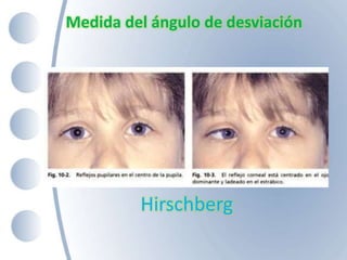 Medida del ángulo de desviación
Hirschberg
 