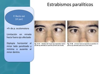 +Fr de p. oculomotora
Limitación en mirada
hacia fuera ojo afectado
Diplopía horizontal al
mirar lado paralizado y
mínima o ausente al
mirar dentro.
Estrabismos paralíticos
P. Recto ext
(VI par)
 