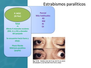 Parcial
Más habituales
RS
RM
RI
OI
Total
-Fr
Afecta 4 músculos oculares
(RM, S,I y OI) y elevador
del parpado
Se encuentra hacia fuera y
abajo.
Ptosis flácida
Midriasis paralitica
(pupila)
Estrabismos paralíticos
P. MOC
(III Par)
 