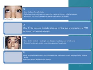 RS
• Mov. Arriba y afuera limitado.
• Diplopía vertical máxima en mirada arriba y afuera/mínima o nula hacia abajo.
• Tortícolis con mentón elevado y cabeza rotada a lado paralizado
OI
Mov. Arriba y dentro limitado, diplopía vertical que provoca discreta PPM
Tortíicolis con mentón elevado
RM
• Mov. dentro limitado = exotropía con diplopía cruzada cuando ve lado sano
• Tortícolis horizontal, mentón en sentido opuesto al paralizado.
RI
• Mov. Abajo y fuera limitado, con diplopia vertical maxima en mirada abajo y afuera/ ausente
arriba
• Tortícolis vertical depresión del mentón
 