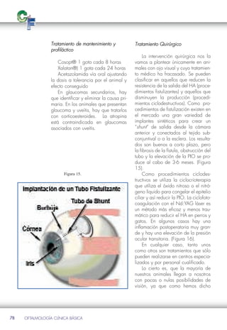 Tratamiento de mantenimiento y             Tratamiento Quirúrgico
                 profiláctico
                                                                 La intervención quirúrgica nos la
                     Cosopt® 1 gota cada 8 horas            vamos a plantear únicamente en ani-
                     Xalatan®) 1 gota cada 24 horas         males con ojo visual y cuyo tratamien-
                     Acetazolamida vía oral ajustando       to médico ha fracasado. Se pueden
                 la dosis a tolerancia por el animal y      clasificar en aquellos que reducen la
                 efecto conseguido                          resistencia de la salida del HA (proce-
                     En glaucomas secundarios, hay          dimientos fistulizantes) y aquellos que
                 que identificar y eliminar la causa pri-   disminuyen la producción (procedi-
                 maria. En los animales que presentan       mientos ciclodestructivos). Como pro-
                 glaucoma y uveítis, hay que tratarlos      cedimientos de fistulización existen en
                 con corticoesteroides. La atropina         el mercado una gran variedad de
                 está contraindicada en glaucomas           implantes sintéticos para crear un
                 asociados con uveítis.                     “shunt” de salida desde la cámara
                                                            anterior y conectados al tejido sub-
                                                            conjuntival o a la esclera. Los resulta-
                                                            dos son buenos a corto plazo, pero
                                                            la fibrosis de la fístula, obstrucción del
                                                            tubo y la elevación de la PIO se pro-
                                                            duce al cabo de 3-6 meses. (Figura

                       Figura 15.
                                                            15).
                                                                 Como procedimientos ciclodes-
                                                            tructivos se utiliza la ciclocrioterapia
                                                            que utiliza el óxido nitroso o el nitró-
                                                            geno líquido para congelar el epitelio
                                                            ciliar y así reducir la PIO. La ciclofoto-
                                                            coagulación con el Nd:YAG láser es
                                                            un método más eficaz y menos trau-
                                                            mático para reducir el HA en perros y
                                                            gatos. En algunos casos hay una
                                                            inflamación postoperatoria muy gran-
                                                            de y hay una elevación de la presión
                                                            ocular transitoria. (Figura 16).
                                                                 En cualquier caso, tanto unos
                                                            como otros son tratamientos que sólo
                                                            pueden realizarse en centros especia-
                                                            lizados y por personal cualificado.
                                                                 Lo cierto es, que la mayoría de
                                                            nuestros animales llegan a nosotros
                                                            con pocas o nulas posibilidades de
                                                            visión, ya que como hemos dicho




78   OFTALMOLOGÍA CLÍNICA BÁSICA
 