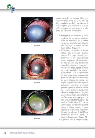 corto intervalo de tiempo. Una pre-
                                           sión de rango entre 40 y 60 mm. de
                                           Hg. produce un daño rápido en el
                                           nervio óptico y en la retina, si la dura-
                                           ción es mayor de una semana la pér-
                                           dida de visión es irreversible.

                                              • hiperemia conjuntival y con-  con-
                                                gestión en los vasos episcle-
                                                                          episcle-
                                                rales se manifiesta en la mayo-

                               Figura 4.
                                                ría de los animales con glauco-
                                                ma. Este signo es menos frecuen-
                                                te en gatos. (Figura 4).
                                              • Cambios corneales y escle-  escle-
                                                rales. Los animales jóvenes
                                                rales
                                                desa-rrollan rápidamente una
                                                buftalmia o un megaloglobo
                                                como respuesta al incremento
                                                de PIO el cual es parcialmente
                                                reversible y tiende a proteger la
                                                retina y el disco óptico durante
                                                un corto periodo. La córnea
                                                sufre edema. Si la PIO permane-
                                                ce alta, se produce una querato-
                                                patía de exposición y la córnea

                               Figura 5.
                                                se ve infiltrada de vasos, las
                                                capas superficiales del epitelio
                                                presentan pigmento e incluso
                                                pueden aparecer úlceras centra-
                                                les. En una buftalmia también se
                                                observa megalocórnea (agran-
                                                damiento corneal), la membrana
                                                de Descemet se rompe y apare-
                                                cen unas líneas blanquecinas lla-
                                                madas “Estrías de a.C.”. A tra-
                                                vés de estas estrías entra directa-
                                                mente el HA al estroma cornée-
                                                la produciendo áreas irregulares
                                                focales de edema. Si la PIO se
                                                normaliza en unas horas, el
                               Figura 6.
                                                edema desaparece. (Figura 5).
                                              • Cambios en el tracto uveal. uveal




72   OFTALMOLOGÍA CLÍNICA BÁSICA
 