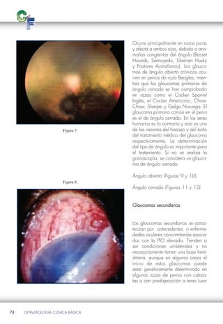 Ocurre principalmente en razas puras
                                   y afecta a ambos ojos, debido a ano-
                                   malías congénitas del ángulo (Basset
                                   Hounds, Samoyedo, Siberian Husky
                                   y Pastores Australianos). Los glauco-
                                   mas de ángulo abierto crónicos ocu-
                                   rren en perros de raza Beagles, mien-
                                   tras que los glaucomas primarios de
                                   ángulo cerrado se han comprobado
                                   en razas como el Cocker Spaniel
                                   Inglés, el Cocker Americano, Chow-
                                   Chow, Sharpei y Galgo Noruego. El
                                   glaucoma primario común en el perro
                                   es el de ángulo cerrado. En los seres

                       Figura 7.
                                   humanos es lo contrario y esta es una
                                   de las razones del fracaso y del éxito
                                   del tratamiento médico del glaucoma
                                   respectivamente. La determinación
                                   del tipo de ángulo es importante para
                                   el tratamiento. Si no se realiza la
                                   gonioscopía, se considera un glauco-
                                   ma de ángulo cerrado.


                       Figura 8.
                                   Ángulo abierto (Figuras 9 y 10).

                                   Ángulo cerrado (Figuras 11 y 12).


                                   Glaucomas secundarios


                                   Los glaucomas secundarios se carac-
                                   terizan por antecedentes o enferme-
                                   dades oculares concomitantes asocia-
                                   das con la PIO elevada. Tienden a
                                   ser condiciones unilaterales y no
                                   necesariamente tienen una base here-
                                   ditaria, aunque en algunos casos el
                                   inicio de estos glaucomas puede
                                   estar genéticamente determinado en
                                   algunas razas de perros con catara-
                                   tas o con predisposición a tener luxa-




74   OFTALMOLOGÍA CLÍNICA BÁSICA
 