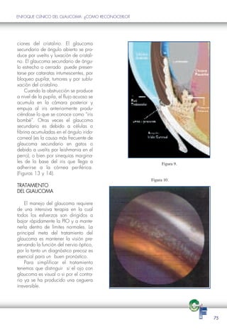 ENFOQUE CLÍNICO DEL GLAUCOMA: ¿COMO RECONOCERLO?




ciones del cristalino. El glaucoma
secundario de ángulo abierto se pro-
duce por uveítis y luxación de cristali-
no. El glaucoma secundario de ángu-
lo estrecho o cerrado puede presen-
tarse por cataratas intumescentes, por
bloqueo pupilar, tumores y por sublu-
xación del cristalino.
    Cuando la obstrucción se produce
a nivel de la pupila, el flujo acuoso se
acumula en la cámara posterior y
empuja al iris anteriormente produ-
ciéndose lo que se conoce como “iris
bombé”. Otras veces el glaucoma
secundario es debido a células o
fibrina acumuladas en el ángulo irido-
corneal (es la causa más frecuente de
glaucoma secundario en gatos o
debido a uveítis por leishmania en el
perro), o bien por sinequias margina-
les de la base del iris que llega a                      Figura 9.
adherirse a la córnea periférica.

                                                   Figura 10.
(Figuras 13 y 14).

TRATAMIENTO
DEL GLAUCOMA

    El manejo del glaucoma requiere
de una intensiva terapia en la cual
todos los esfuerzos son dirigidos a
bajar rápidamente la PIO y a mante-
nerla dentro de límites normales. La
principal meta del tratamiento del
glaucoma es mantener la visión pre-
servando la función del nervio óptico,
por lo tanto un diagnóstico precoz es
esencial para un buen pronóstico.
    Para simplificar el tratamiento
tenemos que distinguir si el ojo con
glaucoma es visual o si por el contra-
rio ya se ha producido una ceguera
irreversible.




                                                                     75
 