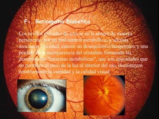 L os niveles elevados de azúcar en la sangre de manera persistente, por un mal control metabólico, y además asociados a la edad, causan un desequilibrio bioquímico y una pérdida de la transparencia del cristalino formando las denominadas "cataratas metabólicas", que son opacidades que no permiten el paso de la luz al interior del ojo, disminuyen notablemente la cantidad y la calidad visual  F-. Retinopatia Diabetica 