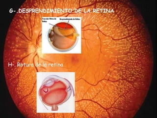 G-.DESPRENDIMIENTO DE LA RETINA H-. Rotura de la retina 