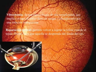 Vi trectomía:  es una microcirugía de alta complejidad, que implica extraer el vítreo lleno de sangre y reemplazarlo por una solución transparente  Reparación retinal:  permite volver a sujetar la retina cuando el tejido fibroso hace que aquella se desprenda del fondo del ojo.   