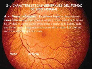 A -. Vasos retinianos:  E n primer lugar  se observan los  vasos retinianos  comprenden la arteria y vena central de la retina. Se dividen en cuatro ramas principales a partir de la papila, cada una de las cuales irriga una cuarta parte de la retina. Las arterias son más estrechas que las venas . Vena  Arteria 2-. CARACTERISTICAS GENERALES DEL FONDO DE OJO NORMAL 