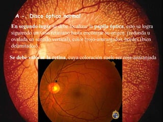 A -. Disco óptico normal E n segundo lugar  se debe localizar la  papila óptica , esto se logra siguiendo un vaso retiniano hasta encontrar su origen. (redonda u ovalada en sentido vertical), color (rojo-anaranjado), bordes (bien delimitados)  S e debe valorar la retina , cuya coloración suele ser roja-anaranjada  