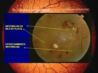 D-. Cambios arteriolares ( esclerosis arteriol ar) 