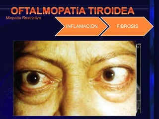 Miopatía Restrictiva
INFLAMACIÓN FIBROSIS
 