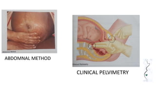 ABDOMNAL METHOD
CLINICAL PELVIMETRY
 