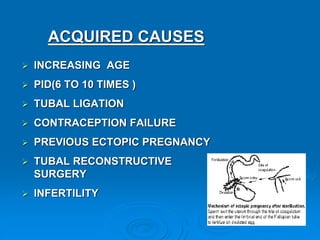 ACQUIRED CAUSES
 INCREASING AGE
 PID(6 TO 10 TIMES )
 TUBAL LIGATION
 CONTRACEPTION FAILURE
 PREVIOUS ECTOPIC PREGNANCY
 TUBAL RECONSTRUCTIVE
SURGERY
 INFERTILITY
 