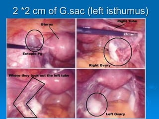2 *2 cm of G.sac (left isthumus)
 