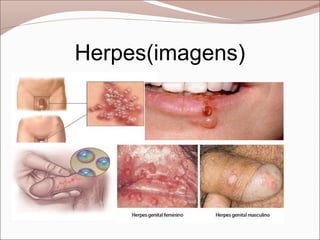 Herpes(imagens)
 