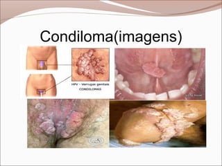 Condiloma(imagens)
 