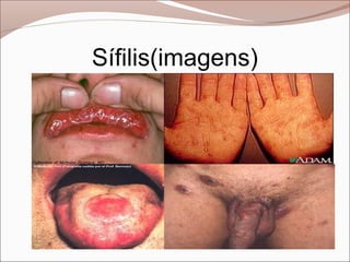 Sífilis(imagens)
 