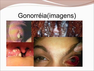 Gonorréia(imagens)
 