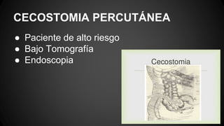 CECOSTOMIA PERCUTÁNEA
● Paciente de alto riesgo
● Bajo Tomografía
● Endoscopia
 