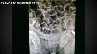 RX SIMPLE DE ABDOMEN DE PIE (F)
 