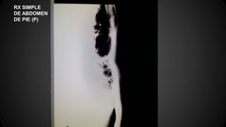 RX SIMPLE
DE ABDOMEN
DE PIE (P)
 